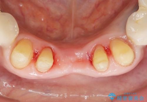前歯が抜けそう ブリッジできれいに 70代女性の治療中