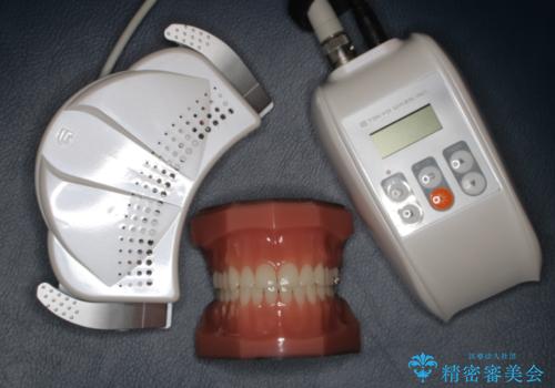 PMTCとホワイトニングの治療中