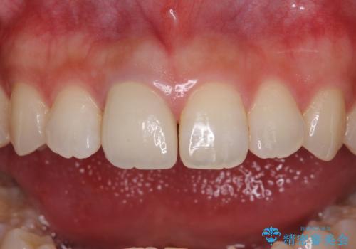 不自然なセラミッククラウンを自然なセラミックにの治療後