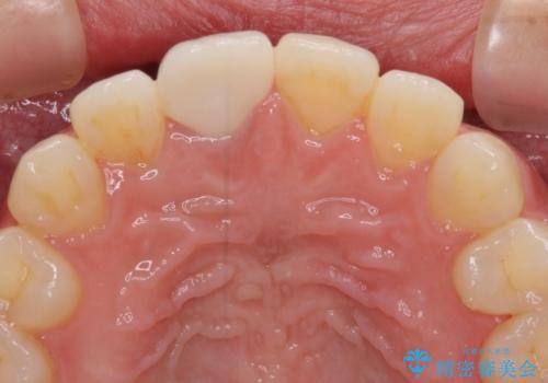 不自然なセラミッククラウンを自然なセラミックにの治療後