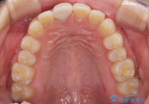 不自然なセラミッククラウンを自然なセラミックにの治療後