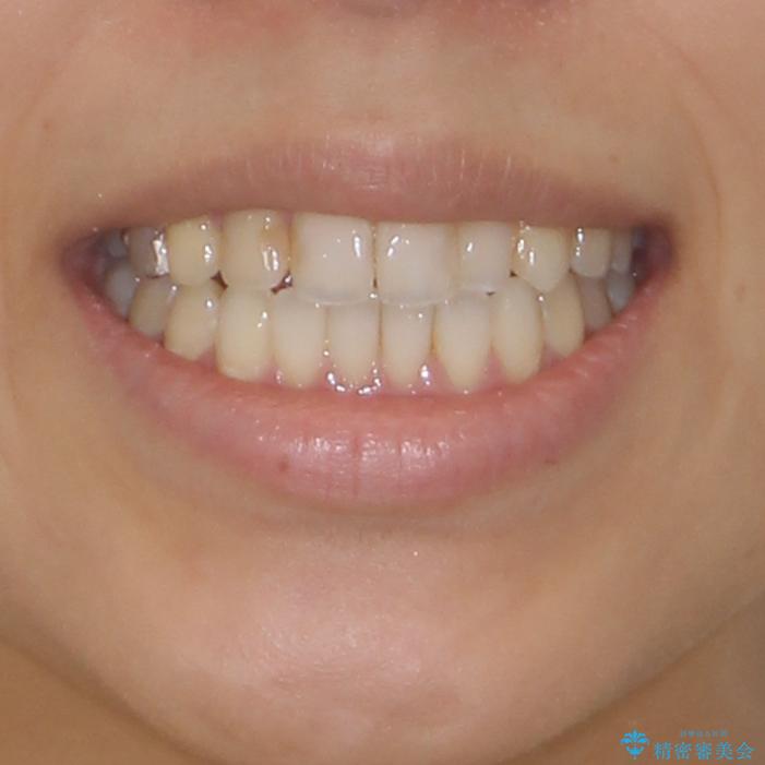 後戻りを治したい 骨格的なズレの大きい方のインビザライン矯正の治療後(顔貌)