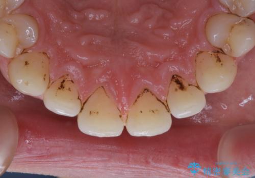 コーヒー紅茶によるステインをPMTCでキレイにの治療前