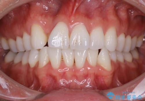 内側に入ってしまった前歯を正しい位置へ  インビザライン矯正の治療前