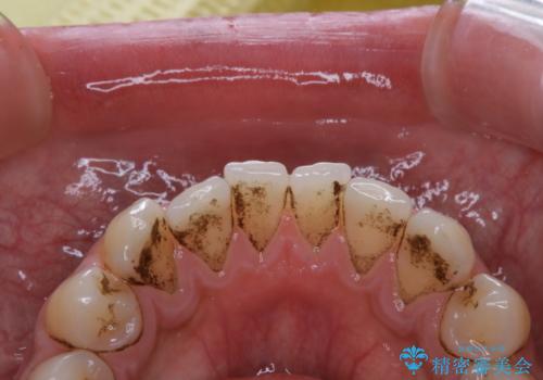 コーヒー紅茶によるステインをPMTCでキレイにの症例 治療前