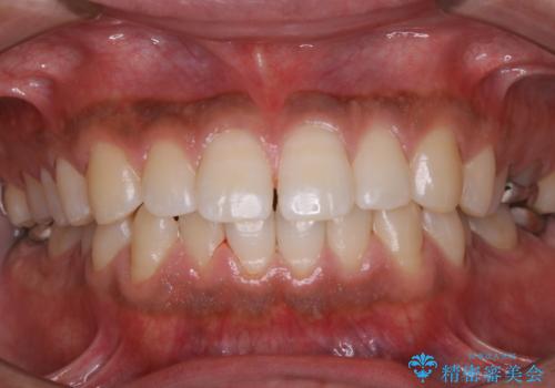 コーヒー紅茶によるステインをPMTCでキレイにの治療後