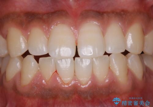 コーヒー紅茶によるステインをPMTCでキレイにの治療後