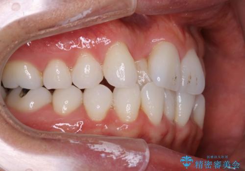 内側に入ってしまった前歯を正しい位置へ  インビザライン矯正の治療前