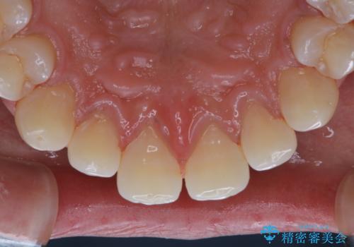 コーヒー紅茶によるステインをPMTCでキレイにの治療後