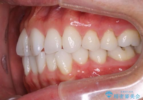 内側に入ってしまった前歯を正しい位置へ  インビザライン矯正の治療前
