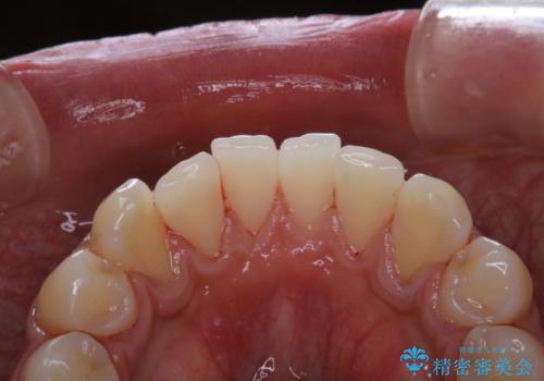 コーヒー紅茶によるステインをPMTCでキレイにの症例 治療後