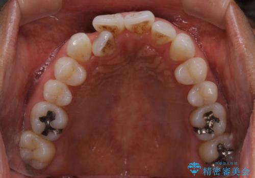 内側に入ってしまった前歯を正しい位置へ  インビザライン矯正の治療前
