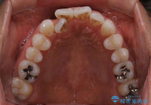 内側に入ってしまった前歯を正しい位置へ　　インビザライン矯正の治療前