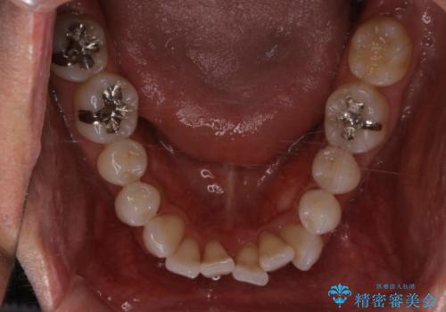 内側に入ってしまった前歯を正しい位置へ　　インビザライン矯正の治療前