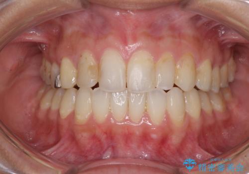 後戻りを治したい 骨格的なズレの大きい方のインビザライン矯正の症例 治療後