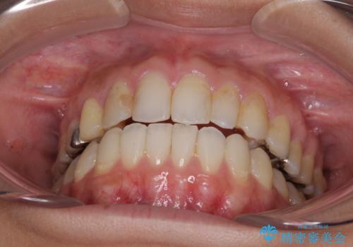 後戻りを治したい 骨格的なズレの大きい方のインビザライン矯正の治療後