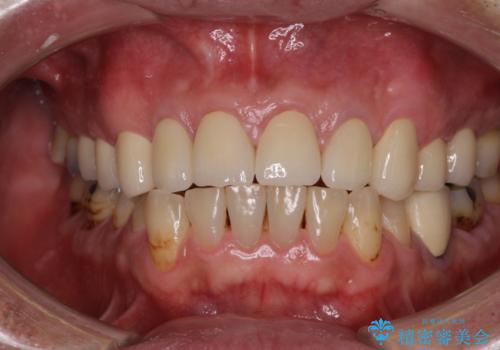 統一感のない前歯を綺麗にしたい　前歯のオールセラミックの治療後