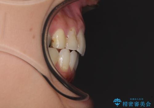 後戻りを治したい 骨格的なズレの大きい方のインビザライン矯正の治療後
