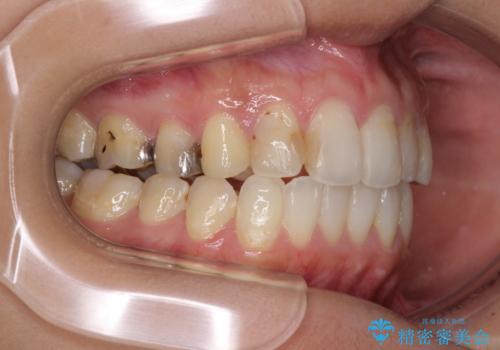 後戻りを治したい 骨格的なズレの大きい方のインビザライン矯正の治療後