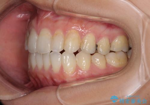 後戻りを治したい 骨格的なズレの大きい方のインビザライン矯正の治療後