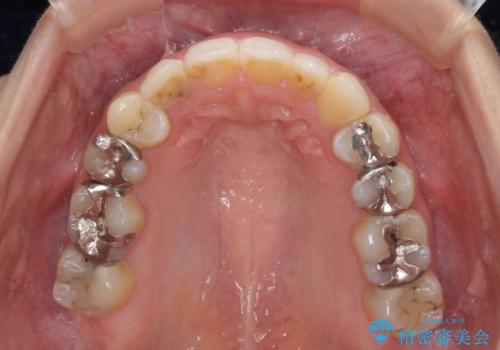 後戻りを治したい 骨格的なズレの大きい方のインビザライン矯正の治療後