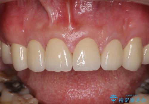 統一感のない前歯を綺麗にしたい　前歯のオールセラミックの治療後