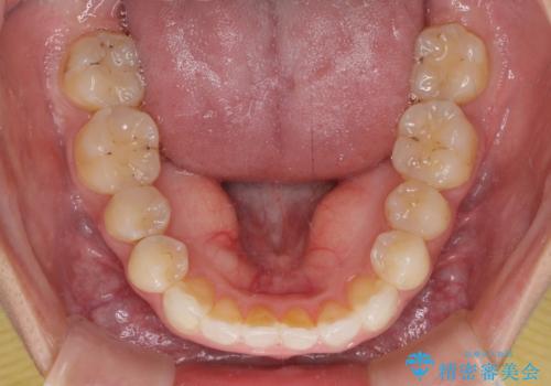 後戻りを治したい 骨格的なズレの大きい方のインビザライン矯正の治療後