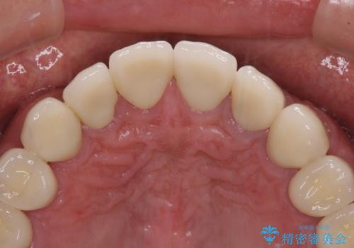統一感のない前歯を綺麗にしたい　前歯のオールセラミックの治療後