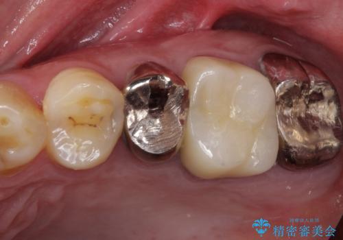 痛い奥歯 セラミッククラウンでのむし歯治療の症例 治療後