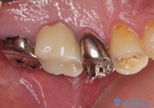 痛い奥歯 セラミッククラウンでのむし歯治療の治療後