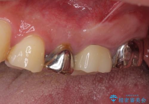 痛い奥歯 セラミッククラウンでのむし歯治療の治療後