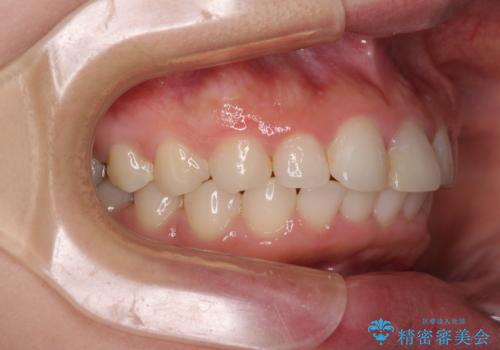 矯正治療の後戻り ガタガタになった前歯の部分矯正の治療後