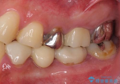 痛い奥歯 セラミッククラウンでのむし歯治療の治療後