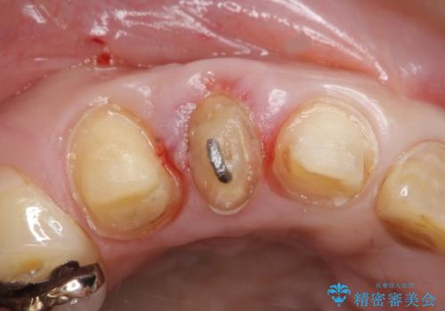 オールセラミッククラウン　下がってしまった前歯の歯茎の改善の治療前