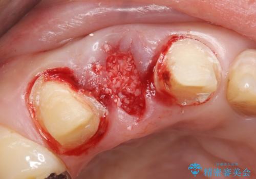 オールセラミッククラウン 下がってしまった前歯の歯茎の改善の治療中