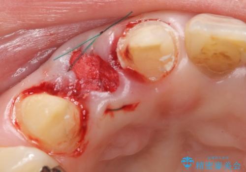 オールセラミッククラウン 下がってしまった前歯の歯茎の改善の治療後