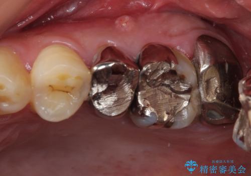 痛い奥歯 セラミッククラウンでのむし歯治療の症例 治療前
