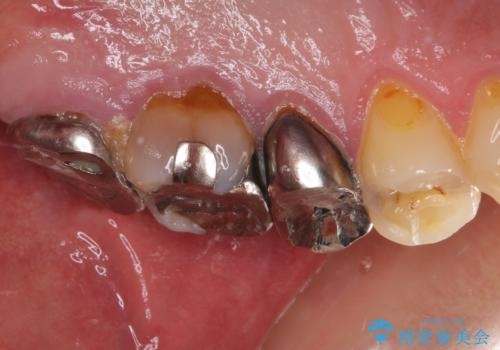 痛い奥歯 セラミッククラウンでのむし歯治療の治療前