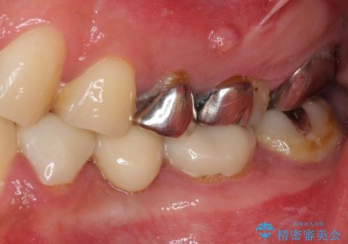 痛い奥歯 セラミッククラウンでのむし歯治療の治療前