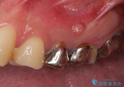 痛い奥歯 セラミッククラウンでのむし歯治療の治療前