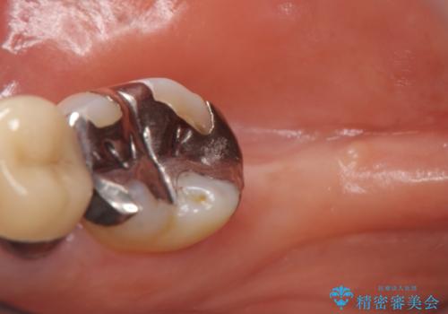 インプラント 抜歯になった奥歯の治療の治療前