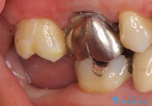 インプラント 抜歯になった奥歯の治療の治療前