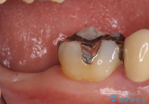インプラント 抜歯になった奥歯の治療の治療前