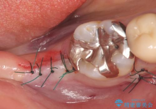 インプラント 抜歯になった奥歯の治療の治療後