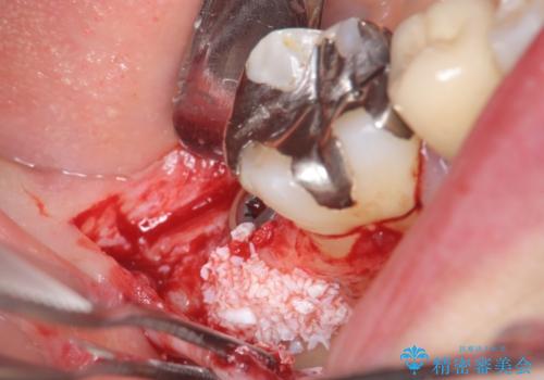 インプラント　抜歯になった奥歯の治療の治療中