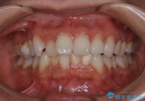 矯正治療前の歯のクリーニング　PMTCの治療前