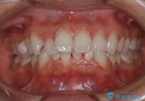 矯正治療前の歯のクリーニング　PMTCの治療後