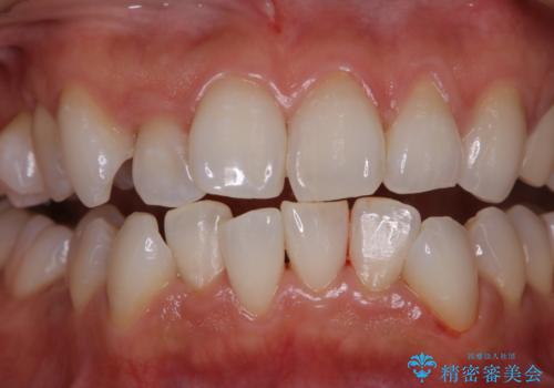 矯正治療前の歯のクリーニング　PMTCの治療後