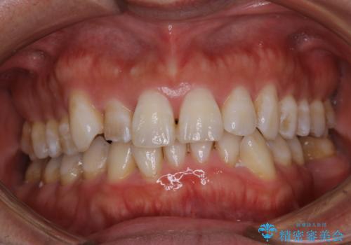 治療前にPMTCでステイン・黄ばみの除去の治療前