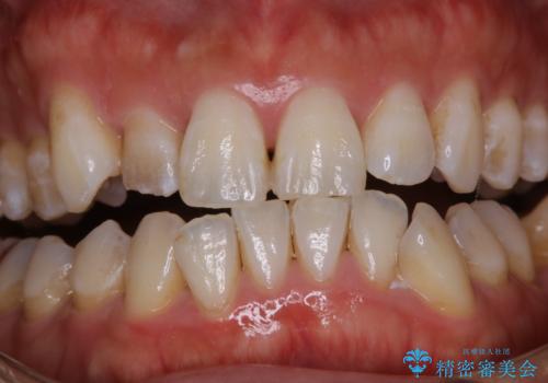 治療前にPMTCでステイン・黄ばみの除去の治療前